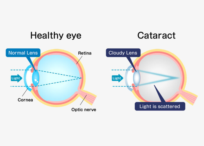 What is a cataract?