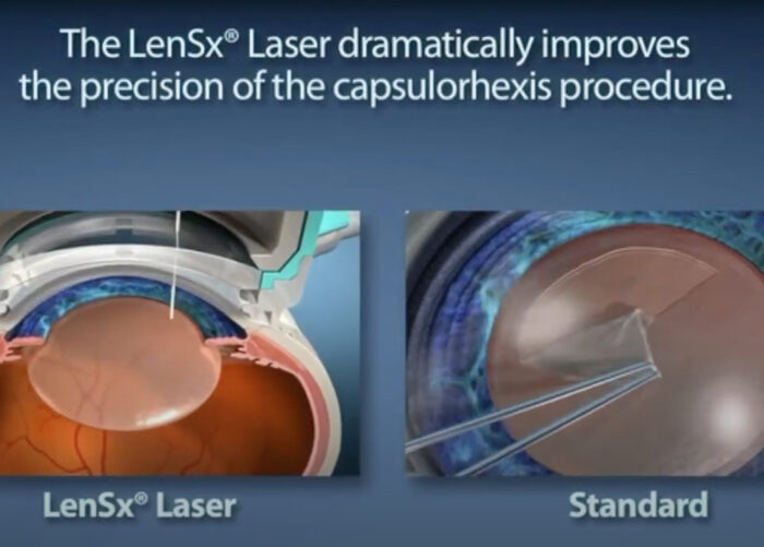 A New Standard in Cataract Surgery video